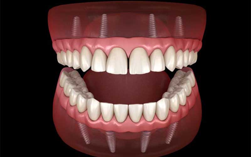 Implant Supported Overdenture